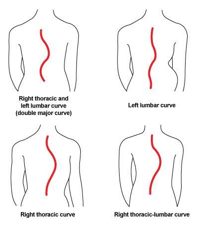 Lordosis Kyphosis And Scoliosis Know The Differences