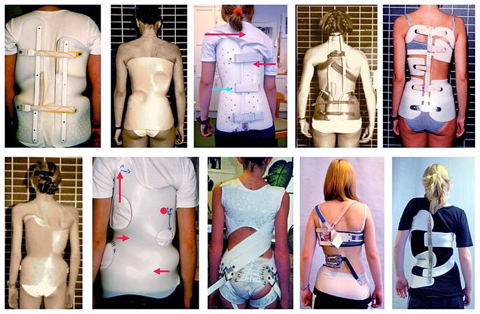 Back and Neck Braces  Used for Scoliosis and Spine Disorders